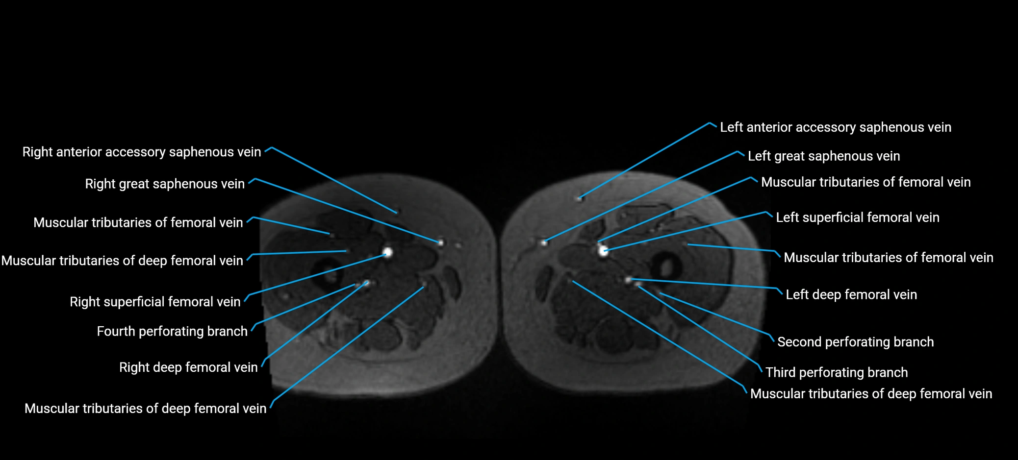 MRV abdomen pelvis & lower limb axial cross sectional anatomy labelled MRI image 249 (1).webp